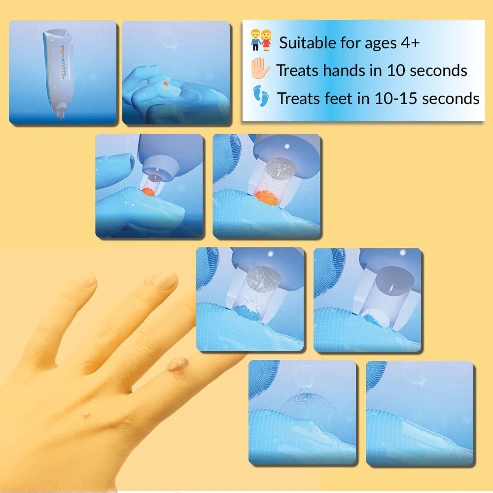 Forwarts Wart Remover